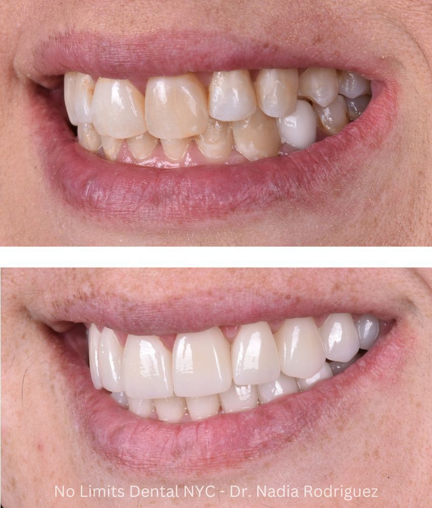 Additional photo 2, crowns were used to restore this smile — No Limits Dental patient 2
