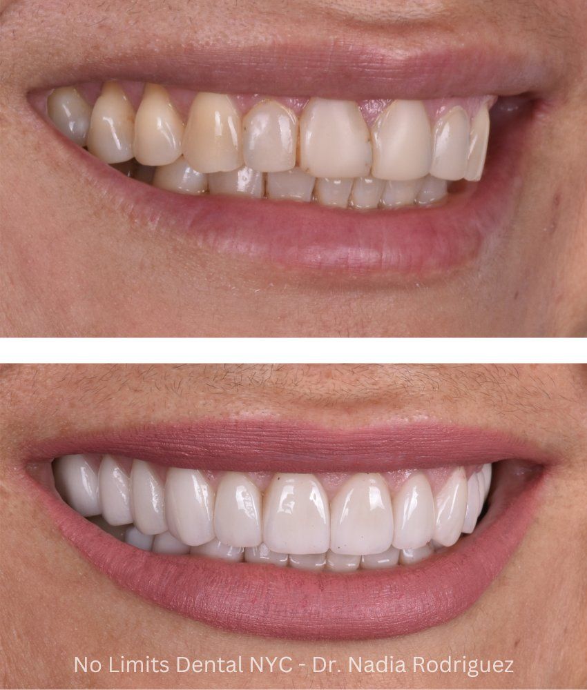 Additional photo 1, crowns, veneers and a bridge were used to restore this smile — No Limits Dental patient 1