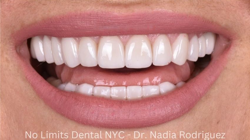 After crowns, veneers and a bridge were used to restore this smile — No Limits Dental patient 1, Midtown Manhattan