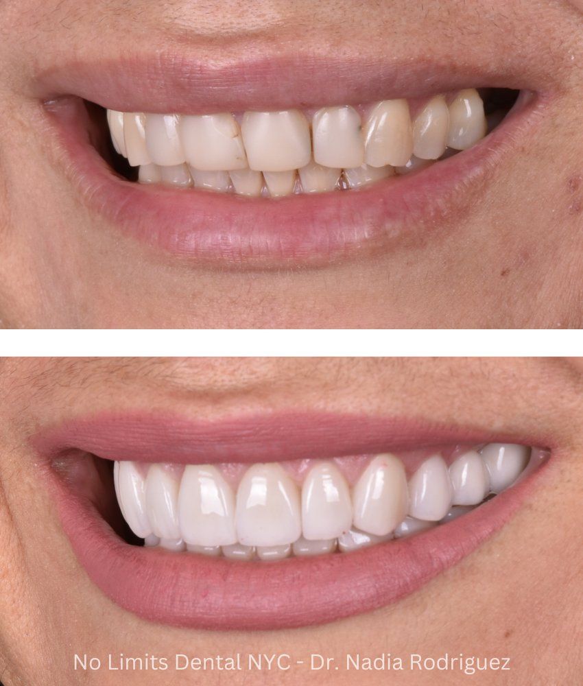 Additional photo 2, crowns, veneers and a bridge were used to restore this smile — No Limits Dental patient 1