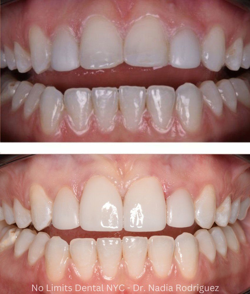 Additional photo 1, two all porcelain veneers were used to restore this smile — No Limits Dental patient 8