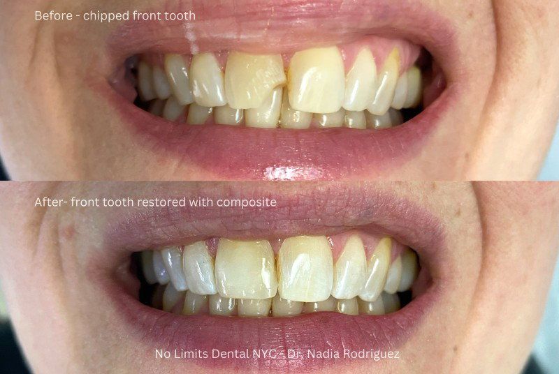 before after tooth chipped