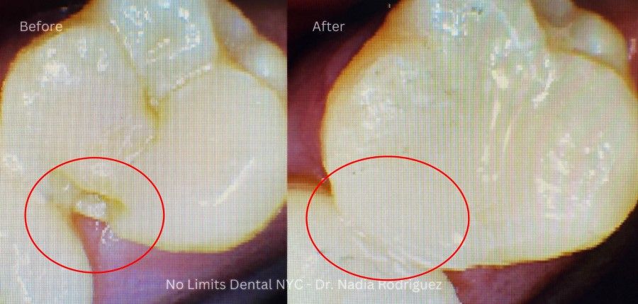 before after filling