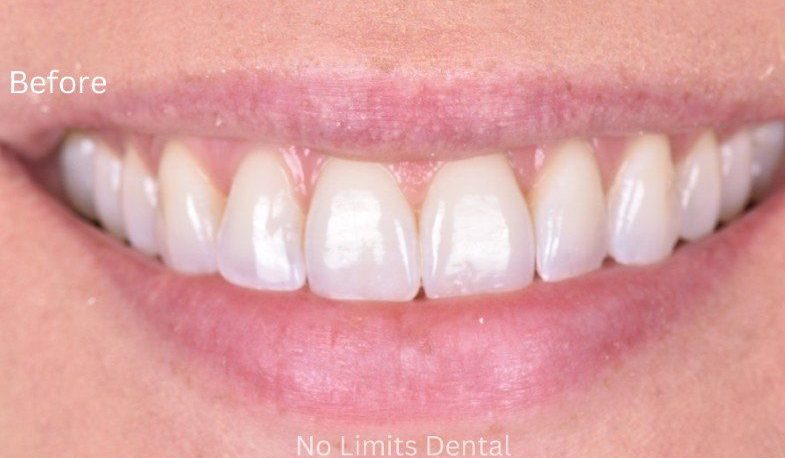 Before teeth whitening — No Limits Dental patient 2, Midtown Manhattan