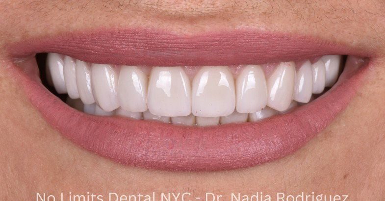 After crowns and veneers — No Limits Dental patient 1, Midtown Manhattan