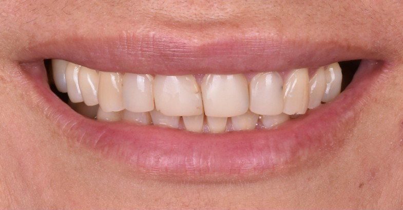 Before crowns and veneers — No Limits Dental patient 1, Midtown Manhattan