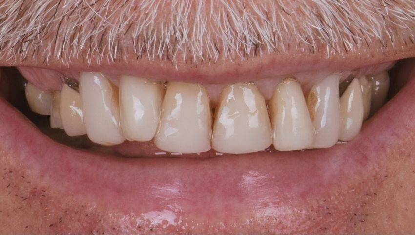 Before porcelain crowns on the top and temporary crowns on the bottom were used to restore this smile — No Limits Dental patient 10, Midtown Manhattan