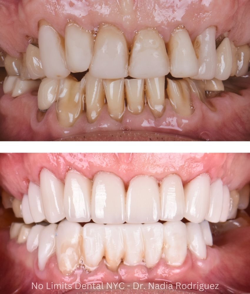 Additional photo 1, porcelain crowns on the top and temporary crowns on the bottom were used to restore this smile — No Limits Dental patient 10