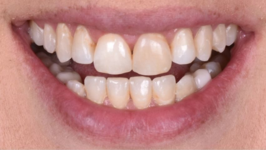 Before crowns were used to restore this smile — No Limits Dental patient 2, Midtown Manhattan