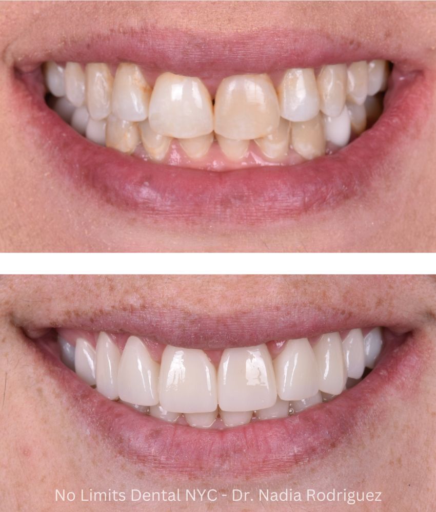 Additional photo 3, crowns were used to restore this smile — No Limits Dental patient 2