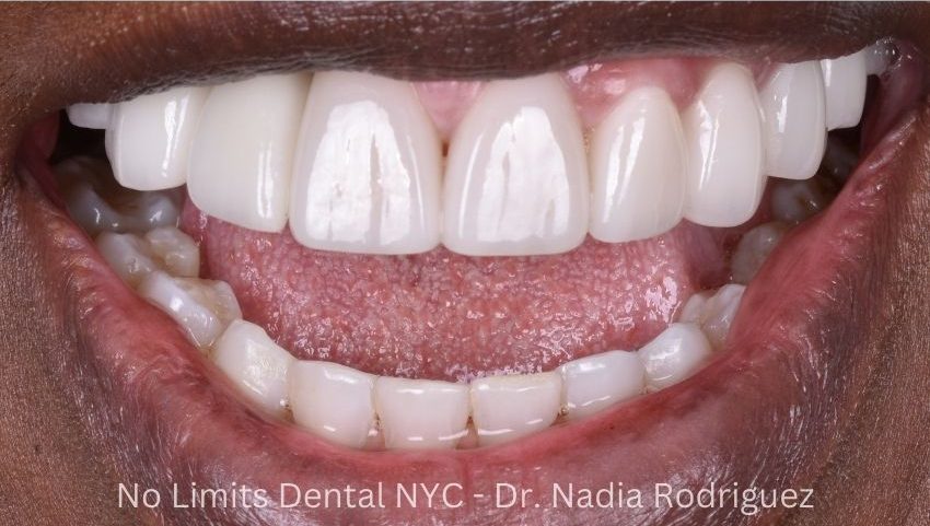 After dental implants, crowns, and veneers were used to restore this smile — No Limits Dental patient 3, Midtown Manhattan