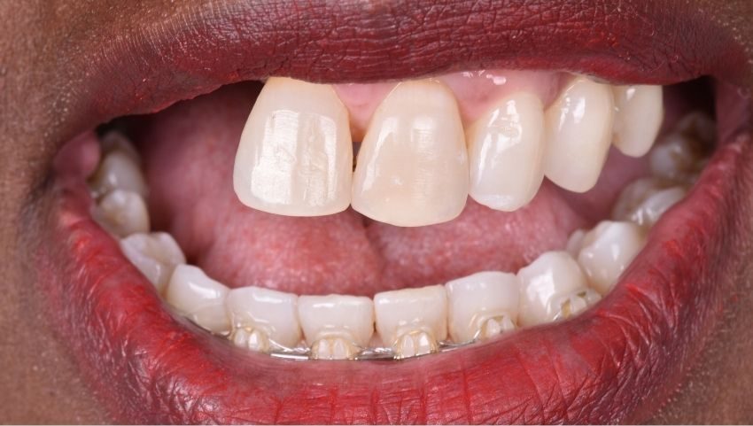 Before dental implants, crowns, and veneers were used to restore this smile — No Limits Dental patient 3, Midtown Manhattan
