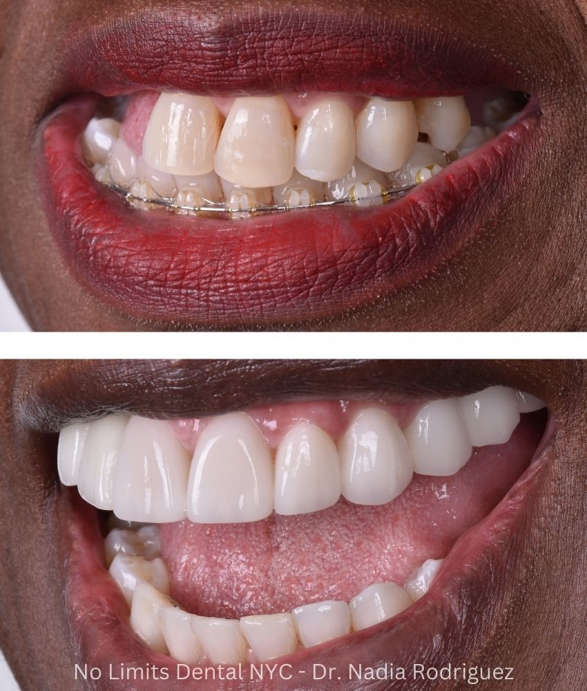 Additional photo 2, dental implants, crowns, and veneers were used to restore this smile — No Limits Dental patient 3