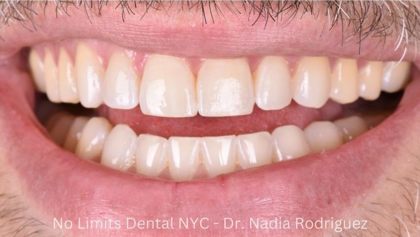 After invisalign, bonding and enamel contouring were used to restore this smile — No Limits Dental patient 4, Midtown Manhattan