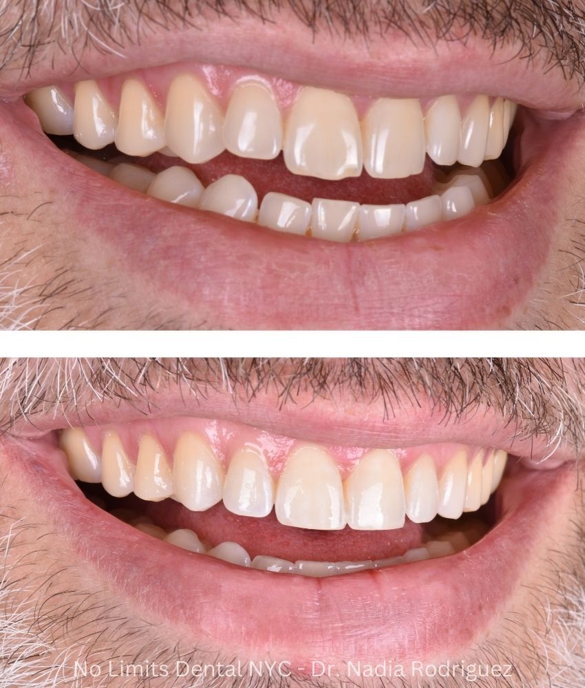 Additional photo 1, invisalign, bonding and enamel contouring were used to restore this smile — No Limits Dental patient 4