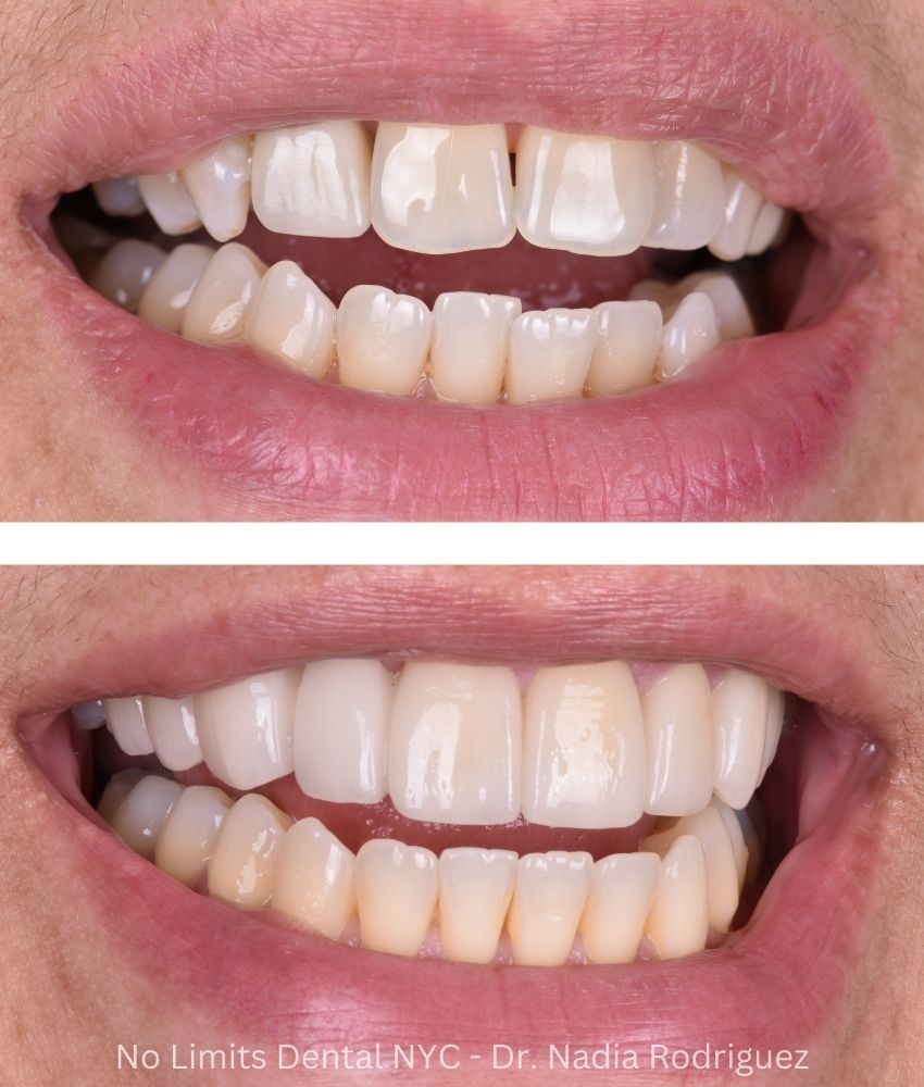 Additional photo 1, invisalign, crowns, a bridge and implants were used to restore this smile — No Limits Dental patient 5