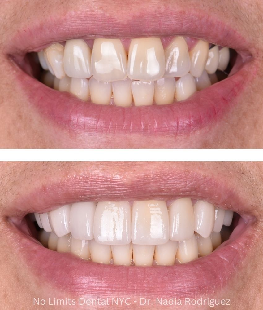 Additional photo 3, invisalign, crowns, a bridge and implants were used to restore this smile — No Limits Dental patient 5