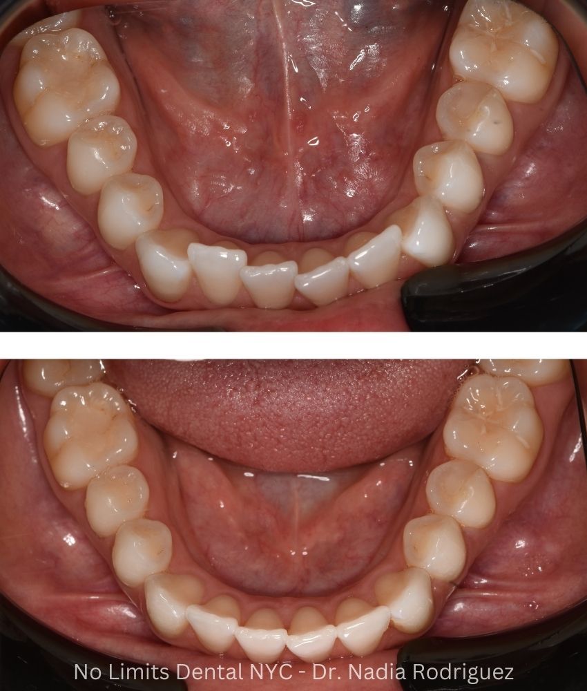 Additional photo 1, invisalign was used for 63 days on the bottom teeth to restore this smile — No Limits Dental patient 6