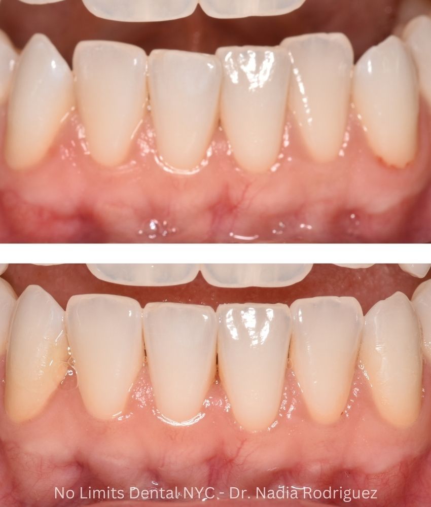 Additional photo 2, invisalign was used for 63 days on the bottom teeth to restore this smile — No Limits Dental patient 6