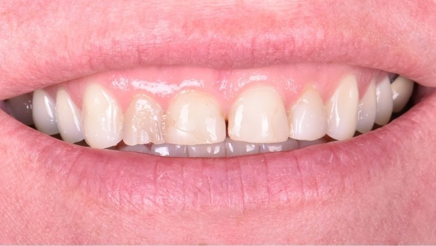Before four all porcelain crowns restored this smile — No Limits Dental patient 7, Midtown Manhattan