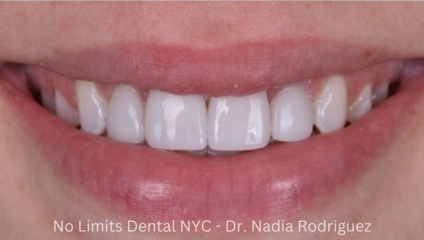 After two all porcelain veneers were used to restore this smile — No Limits Dental patient 8, Midtown Manhattan
