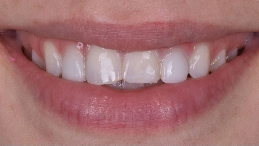 Before two all porcelain veneers were used to restore this smile — No Limits Dental patient 8, Midtown Manhattan