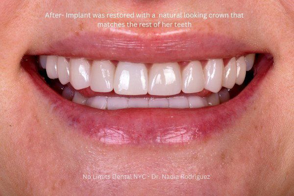 Broken front tooth replaced with a dental implant crown