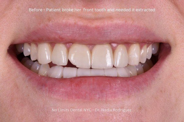 Broken front tooth before treatment
