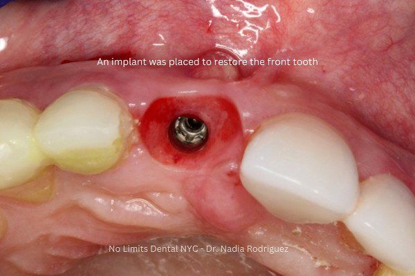Implant post placed to replace the broken front tooth