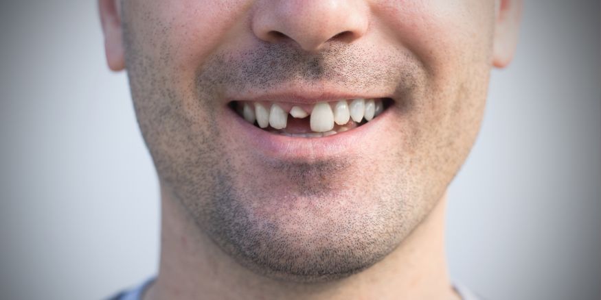 chipped tooth example