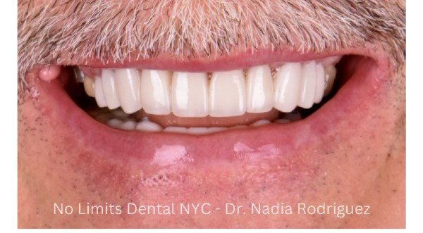After cosmetic dental work — No Limits Dental patient 1, Midtown Manhattan