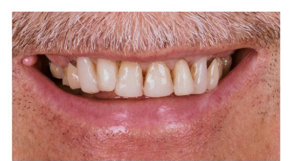 Before cosmetic dental work — No Limits Dental patient 1, Midtown Manhattan