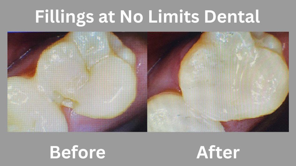 filling before after
