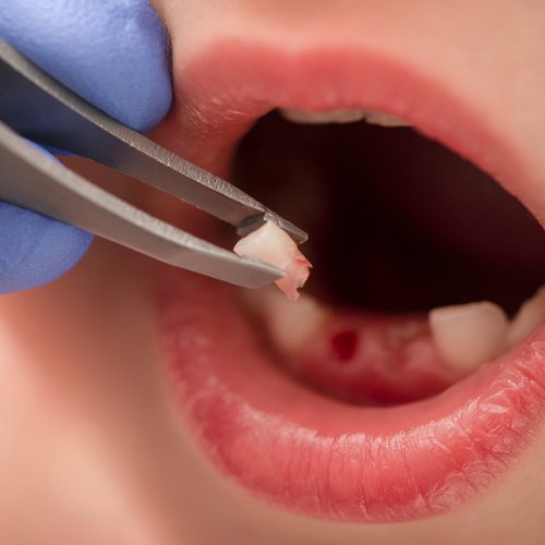 Tooth removal
