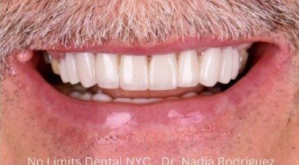 After cosmetic dental work — No Limits Dental patient 2, Midtown Manhattan