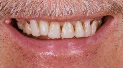 Before cosmetic dental work — No Limits Dental patient 2, Midtown Manhattan