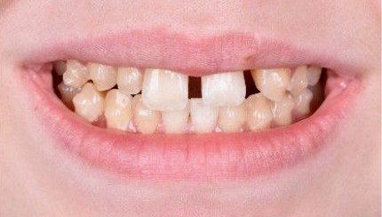 Before cosmetic dental work — No Limits Dental patient 3, Midtown Manhattan