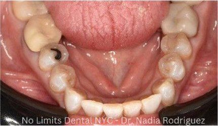 After cosmetic dental work — No Limits Dental patient 4, Midtown Manhattan