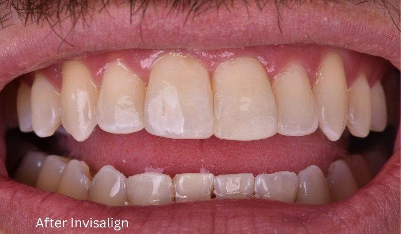 After Invisalign treatment — No Limits Dental patient 1, Midtown Manhattan