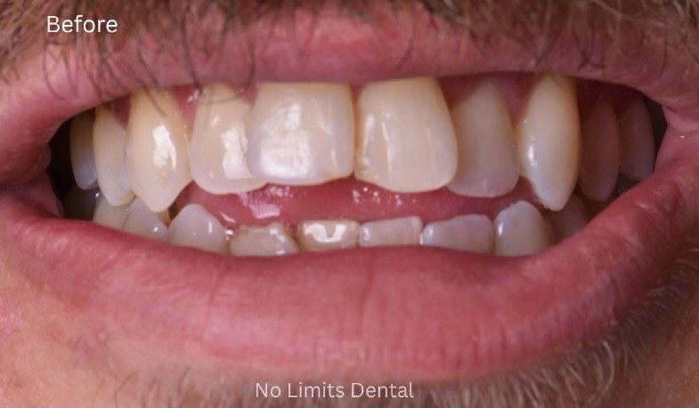 Before Invisalign treatment — No Limits Dental patient 1, Midtown Manhattan