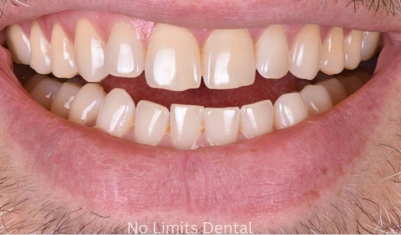 Before Invisalign treatment — No Limits Dental patient 2, Midtown Manhattan
