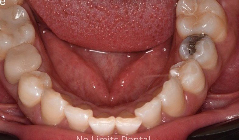 Before Invisalign treatment — No Limits Dental patient 3, Midtown Manhattan