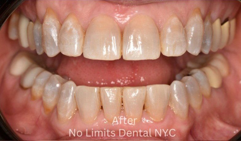 After Invisalign treatment — No Limits Dental patient 4, Midtown Manhattan
