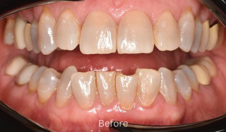 Before Invisalign treatment — No Limits Dental patient 4, Midtown Manhattan