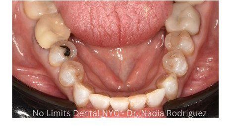After cosmetic dental work — No Limits Dental patient 2, Midtown Manhattan