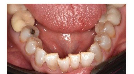Before cosmetic dental work — No Limits Dental patient 2, Midtown Manhattan