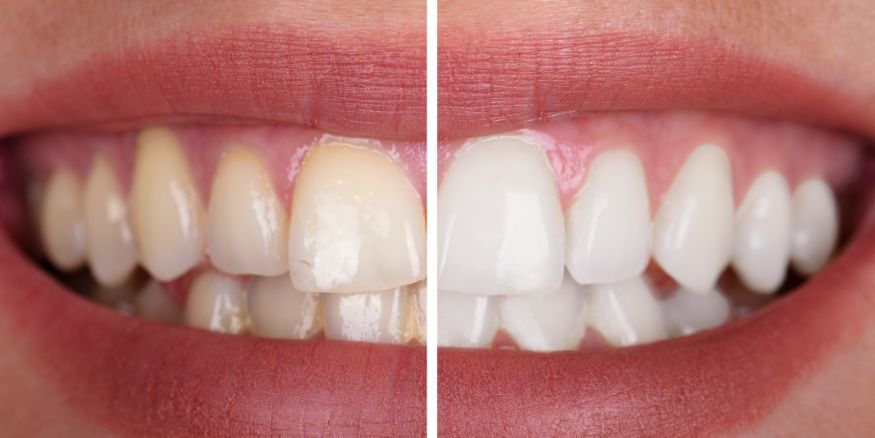 teeth whitening veneers