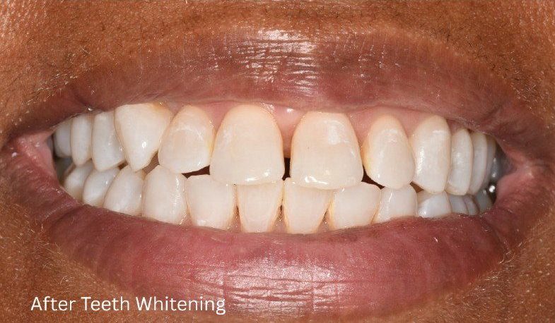 After teeth whitening — No Limits Dental patient 1, Midtown Manhattan