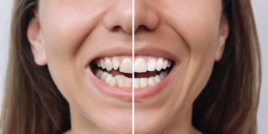 crooked teeth fix veneers