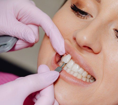 veneers dentist manhattan